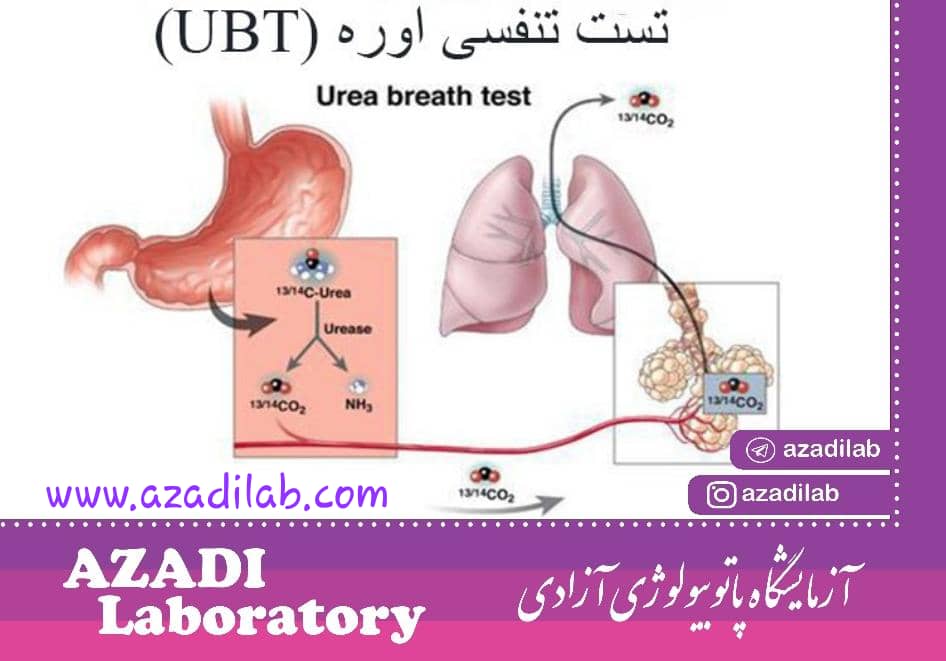 تست تنفسی UBT